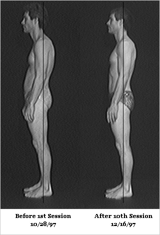 Rolfing Before and After Photos